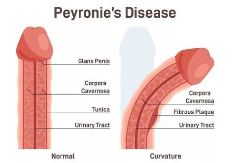 All You Need To Know About Peyronie’s