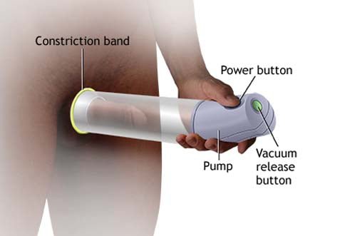 Risks and Side Effects of Penis Pump